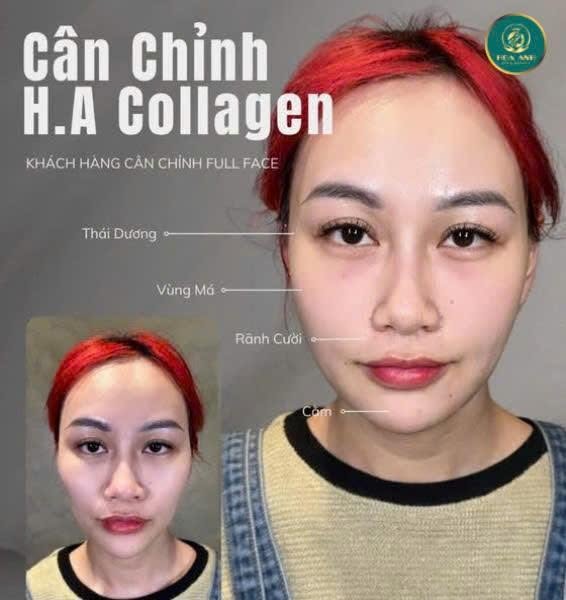 Cân chỉnh HA Collagen full face tại Hoa Anh — ca 2